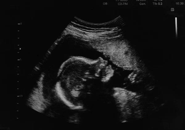 未出生婴儿在母亲子宫的超声照片, 特写镜头 — 图库照片