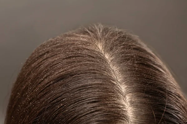 Woman with dandruff in her dark hair on grey background, closeup — Stock Photo, Image