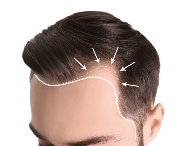 Jovem com problema de perda de cabelo no fundo branco, close-up — Fotografia de Stock