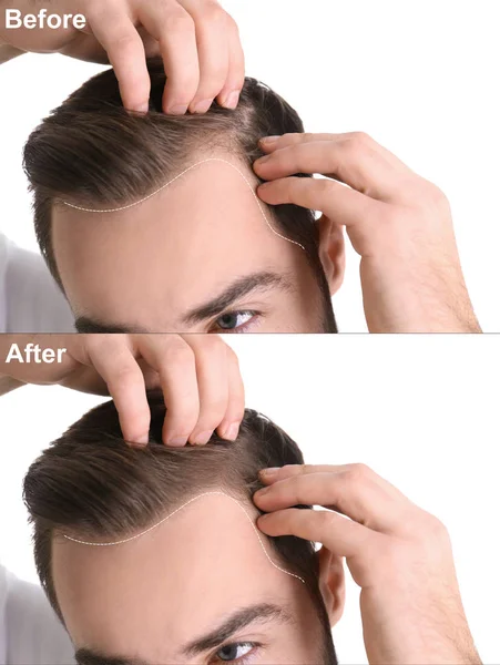 Young man before and after hair loss treatment against white background, closeup — ストック写真