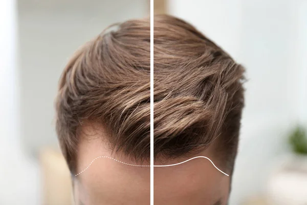 Young man before and after hair loss treatment against blurred background, closeup — Stock Photo, Image