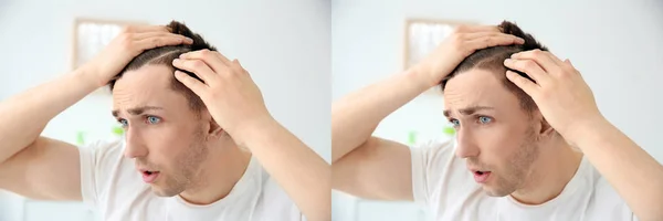 Young man before and after hair loss treatment indoors — Stock Photo, Image