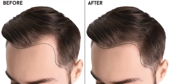 Young man before and after hair loss treatment against white background, closeup — ストック写真