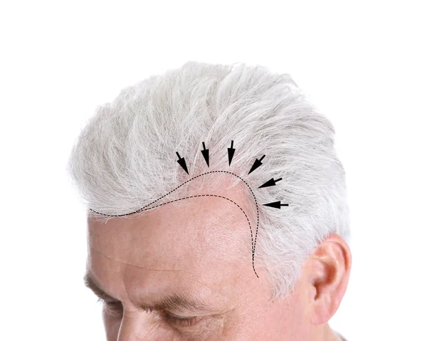 Senior Mann mit Haarausfall Problem auf weißem Hintergrund, Nahaufnahme — Stockfoto