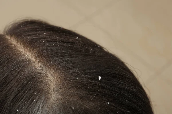 Woman with dandruff in her dark hair on blurred background, closeup view — Stock Photo, Image