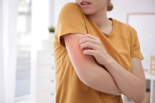 Woman scratching arm indoors, closeup with space for text. Allergy symptoms — Stock Photo, Image