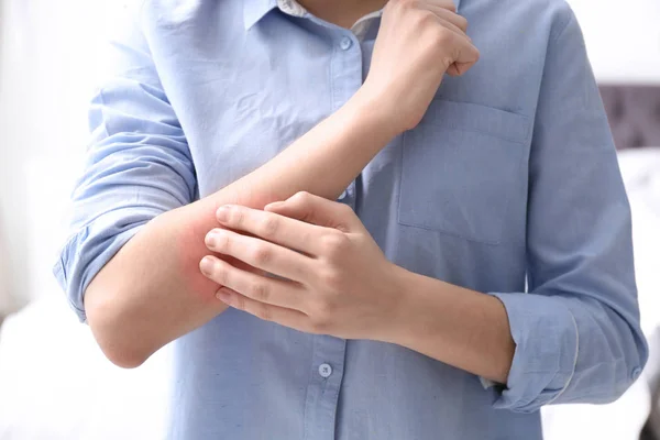 Young woman scratching hand indoors, closeup. Allergies symptoms — Stock Photo, Image