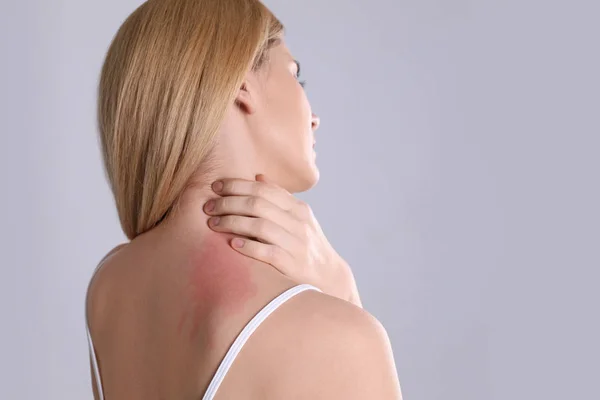 Mujer con síntomas de alergia arañando el cuello sobre fondo gris. Espacio para texto —  Fotos de Stock