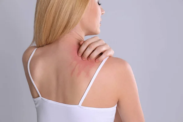 Mujer con síntomas de alergia rascarse el hombro sobre fondo gris, primer plano — Foto de Stock