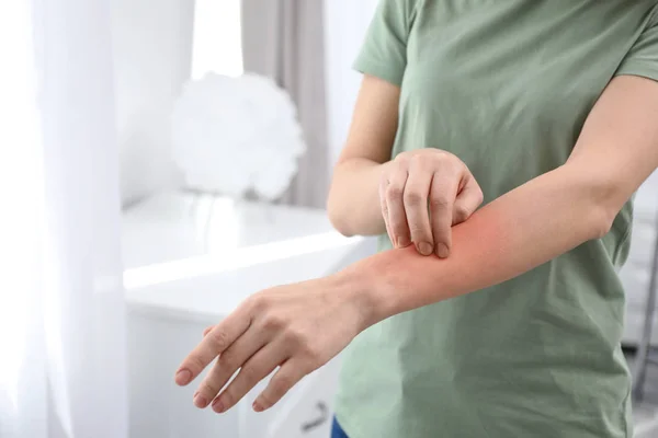 Woman with allergy symptoms scratching forearm indoors, closeup. Space for text — Stock Photo, Image