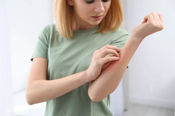 Woman with allergy symptoms scratching forearm indoors, closeup — Stock Photo, Image