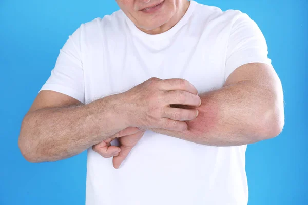 Senior Mann kratzt Unterarm auf farbigem Hintergrund, Nahaufnahme. Allergie-Symptom — Stockfoto