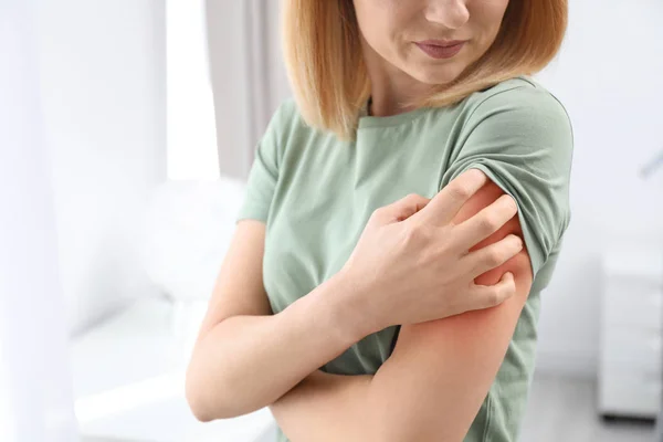 Mujer con síntomas de alergia rascarse el brazo en el interior, primer plano. Espacio para texto — Foto de Stock