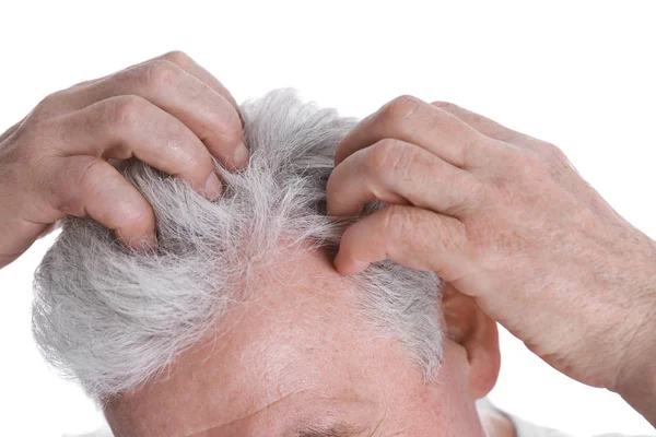 Ανώτερος άνθρωπος με πρόβλημα απώλειας μαλλιών απομονώνεται σε λευκό, κοντινό πλάνο — Φωτογραφία Αρχείου