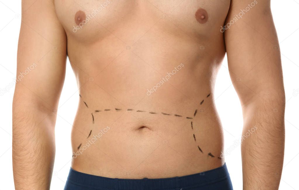 Young man with marks on belly for cosmetic surgery operation against white background, closeup