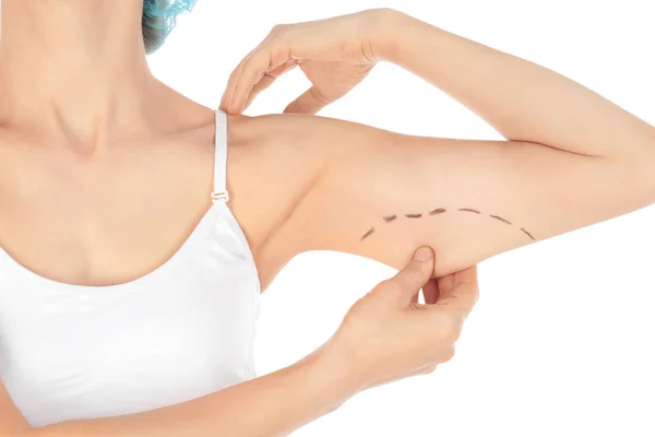 Mujer con marcas en el brazo para la operación de cirugía estética sobre fondo blanco, primer plano — Foto de Stock