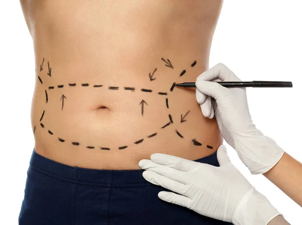 Marcas de dibujo médico en el cuerpo del hombre para la operación de cirugía estética contra el fondo blanco, primer plano — Foto de Stock