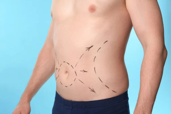 Homme avec des marques sur le ventre pour l'opération de chirurgie esthétique sur fond bleu, gros plan — Photo