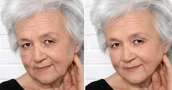 Belle femme mature avant et après la procédure de biorevitalisation — Photo