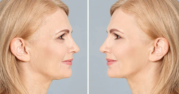 Wanita dewasa yang cantik sebelum dan sesudah prosedur biorevitalisasi pada latar belakang abu-abu — Stok Foto