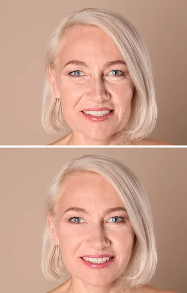 Beautiful mature woman before and after biorevitalization procedure on beige background