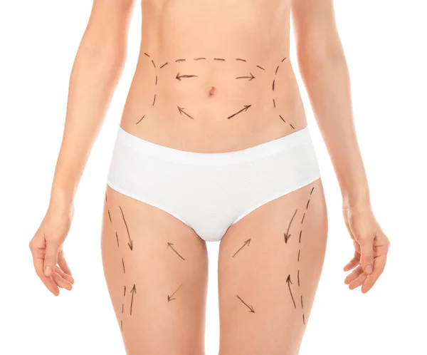 Mulher com marcas no corpo para cirurgia estética operação contra fundo branco, close-up — Fotografia de Stock