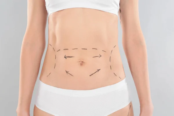 Woman with marks on body for cosmetic surgery operation against grey background, closeup — Stock Photo, Image