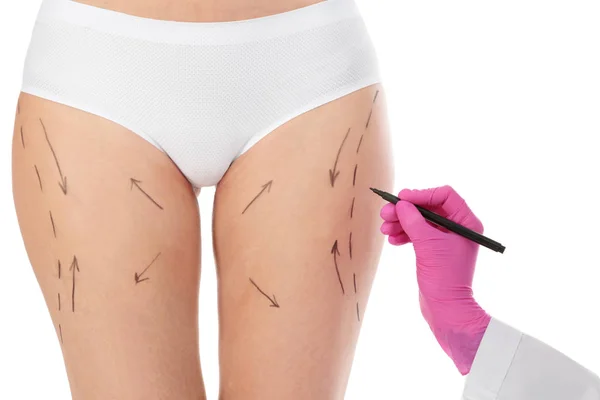 Marcas de desenho médico no corpo da mulher, isoladas em branco. Cirurgia estética — Fotografia de Stock