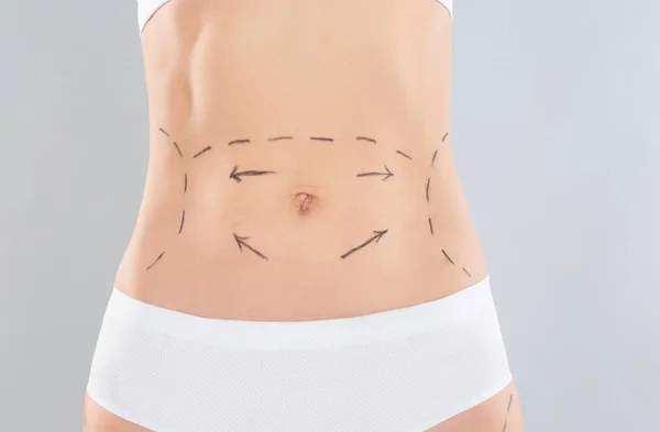 Woman with marks on body for cosmetic surgery operation against grey background, closeup — Stock Photo, Image