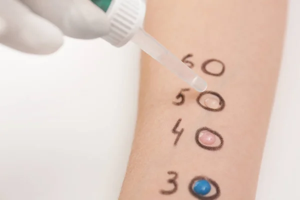 Пациент проходит тест на аллергию на кожу за светлым столом, крупным планом — стоковое фото