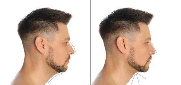 Ο άνθρωπος πριν και μετά από πλαστική χειρουργική επέμβαση σε λευκό φόντο — Φωτογραφία Αρχείου