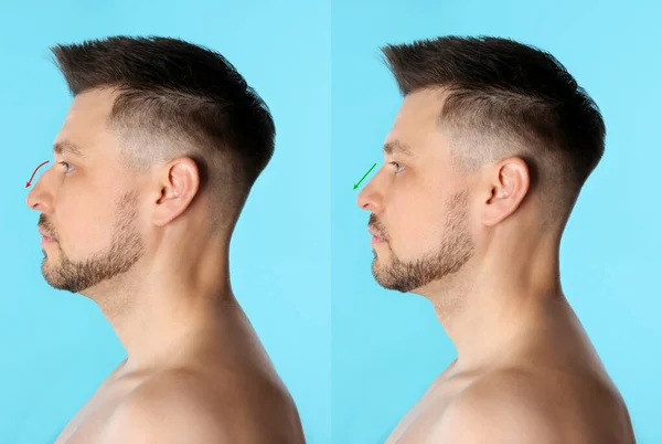 Hombre antes y después de la cirugía plástica sobre fondo azul claro — Foto de Stock