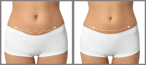 Женщина до и после пластической операции на белом фоне — стоковое фото