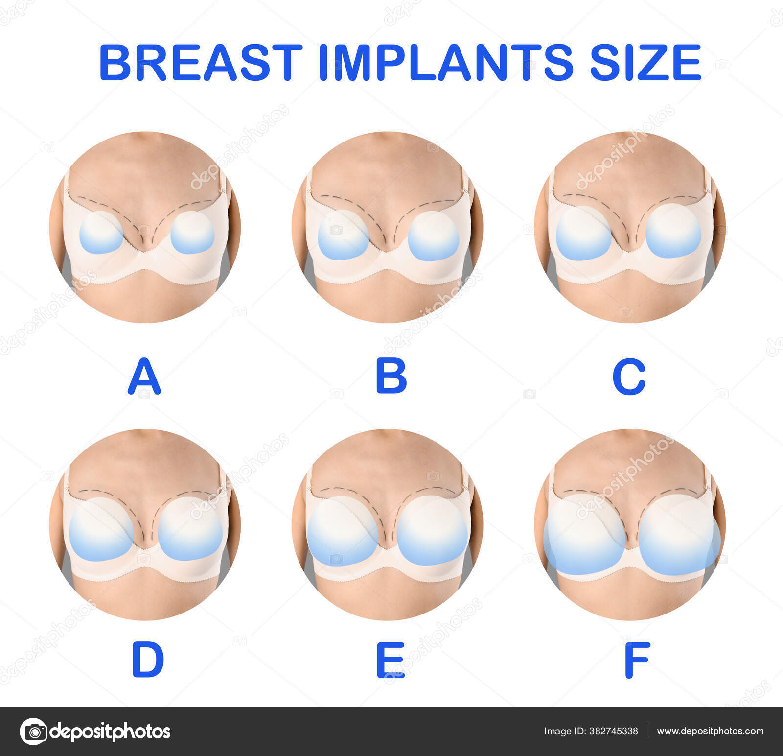 Collage Photos Woman Demonstrating Different Implant Sizes Breast White  Background Stock Photo by ©NewAfrica 382745338