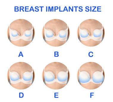 Beyaz arka planda göğüsler için farklı implant boyutları gösteren fotoğraflarla kolaj, yakın plan.