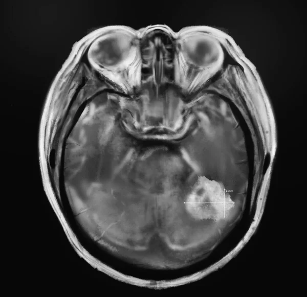 Röntgenbild Eines Patienten Mit Gehirnkrebs Illustration — Stockfoto