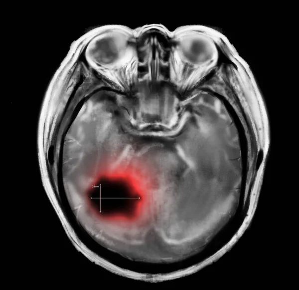 Radiografía Del Paciente Con Cáncer Cerebral Ilustración —  Fotos de Stock