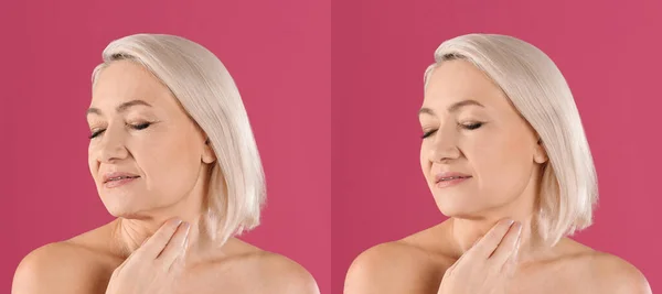 Ältere Frau Vor Und Nach Kosmetischen Eingriff Auf Rosa Hintergrund — Stockfoto
