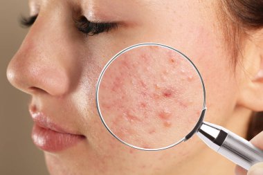 Teenage girl with acne problem visiting dermatologist, closeup. Skin under magnifying glass clipart
