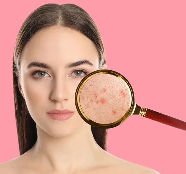 ピンクの背景ににきびの問題を持つ若い女性 虫眼鏡の下の皮膚 — ストック写真