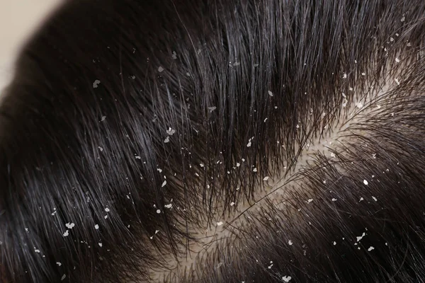 Женщина Перхоти Темных Волосах Вид Крупным Планом — стоковое фото