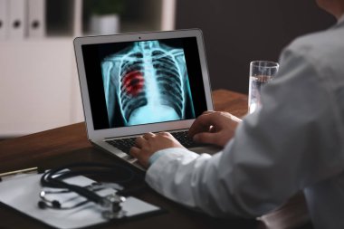 Klinikteki laptopta akciğer kanseri olan hastanın röntgenini inceleyen doktor.