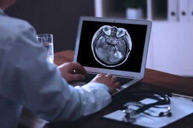 Doctor examining x-ray of patient with brain cancer on laptop in clinic, closeup clipart