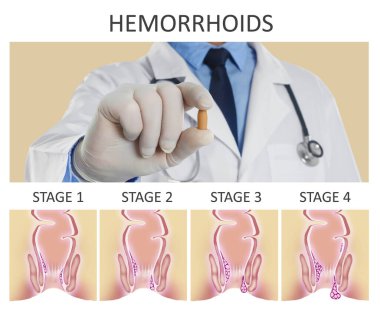 Doktor hemoroid tedavisi için fitil tutuyor rektum ilerlemesi hastalığının resmedilmesi üzerine.