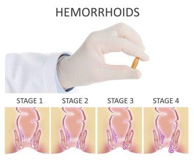 Doktor hemoroid tedavisi için fitil tutuyor rektum ilerlemesi hastalığının resmedilmesi üzerine.
