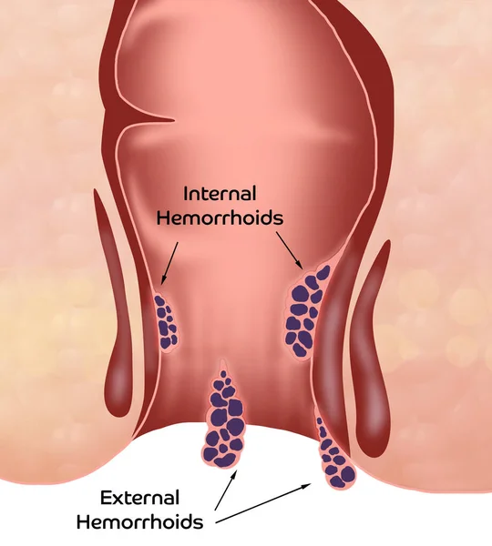 Hemorroides Recto Inferior Malsano Con Estructuras Vasculares Inflamadas Ilustración — Foto de Stock