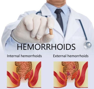 Doktor, sağlıksız rektum çizimleri üzerine hemoroit tedavisi için fitil tutuyor. 