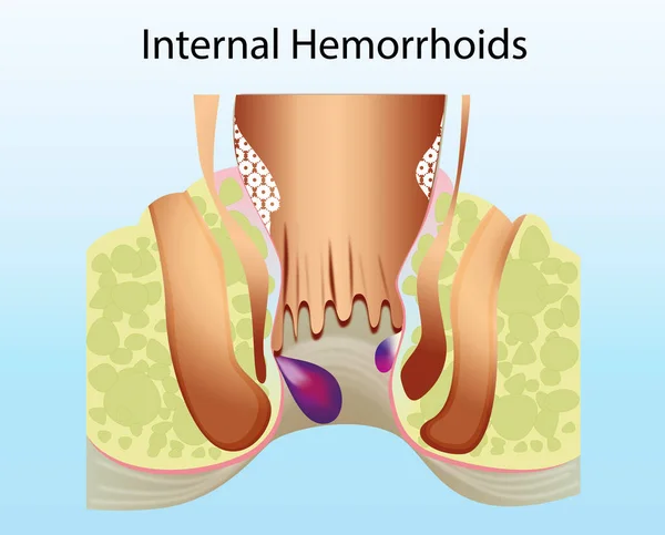 Hemorroides Internas Recto Inferior Malsano Con Estructuras Vasculares Inflamadas Ilustración —  Fotos de Stock