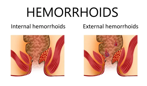 Tipos Hemorroides Recto Inferior Malsano Con Estructuras Vasculares Inflamadas Ilustración —  Fotos de Stock