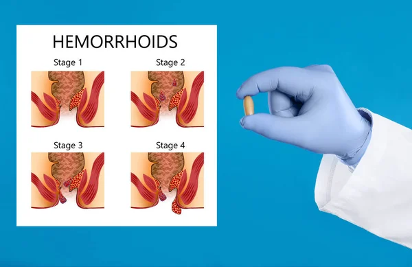 Dokter Die Zetpil Voor Aambeien Behandeling Buurt Illustratie Van Lagere — Stockfoto